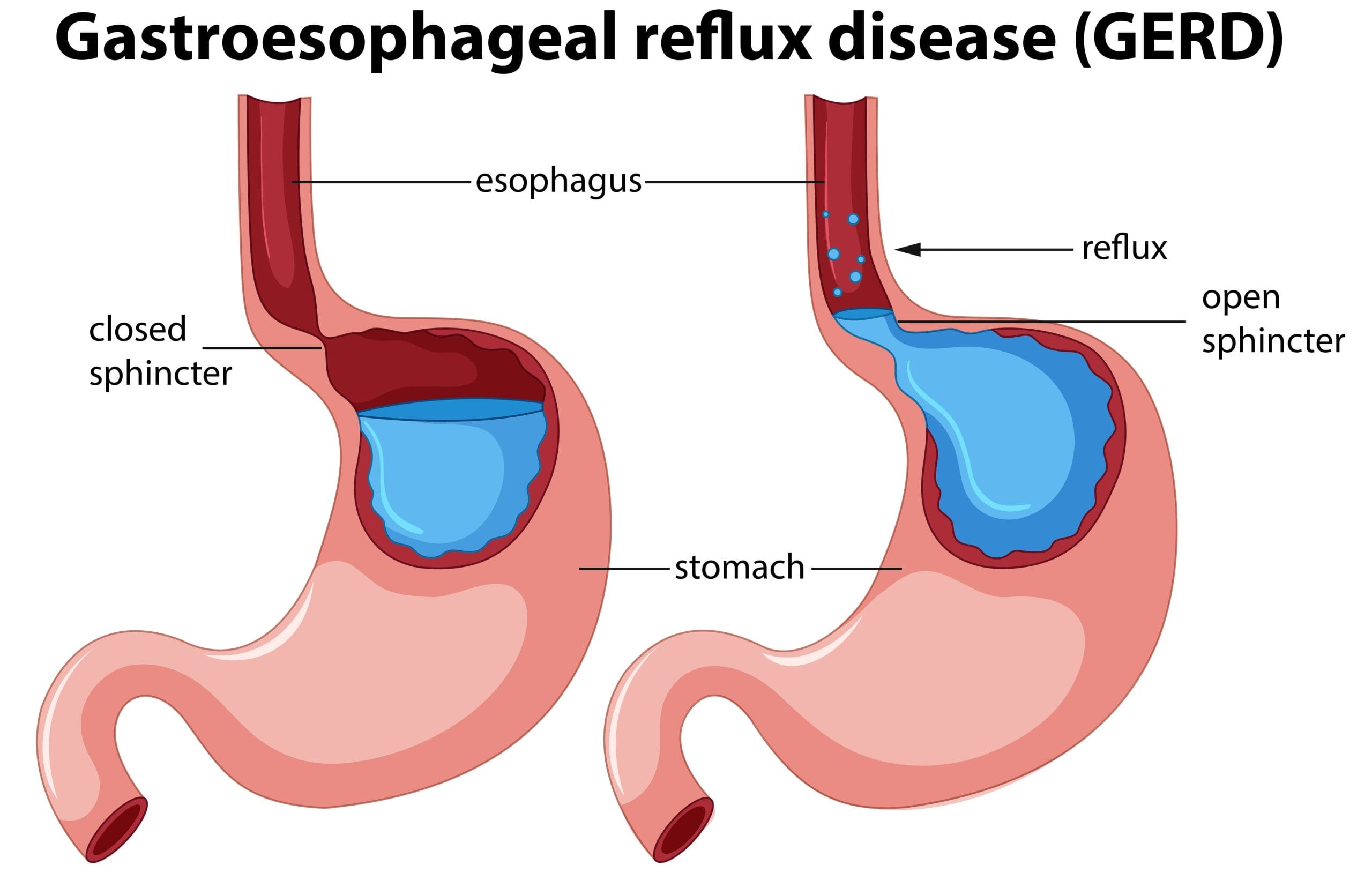 gastroesophageal reflux disease (GERD)