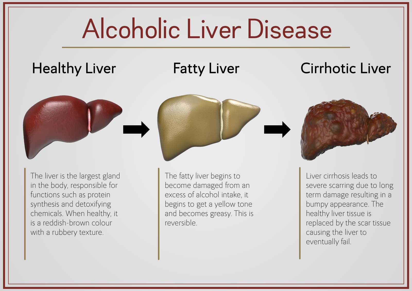 alcoholic liver disease symptoms pictures