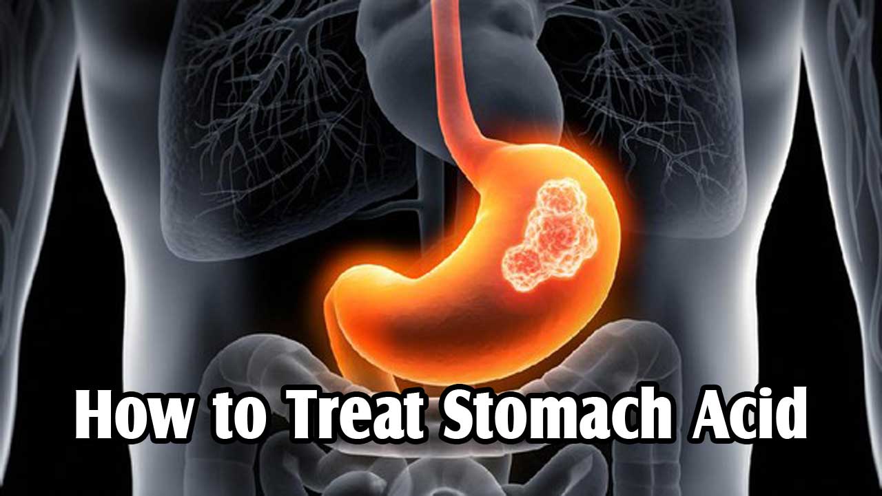 How to Treat Stomach Acid