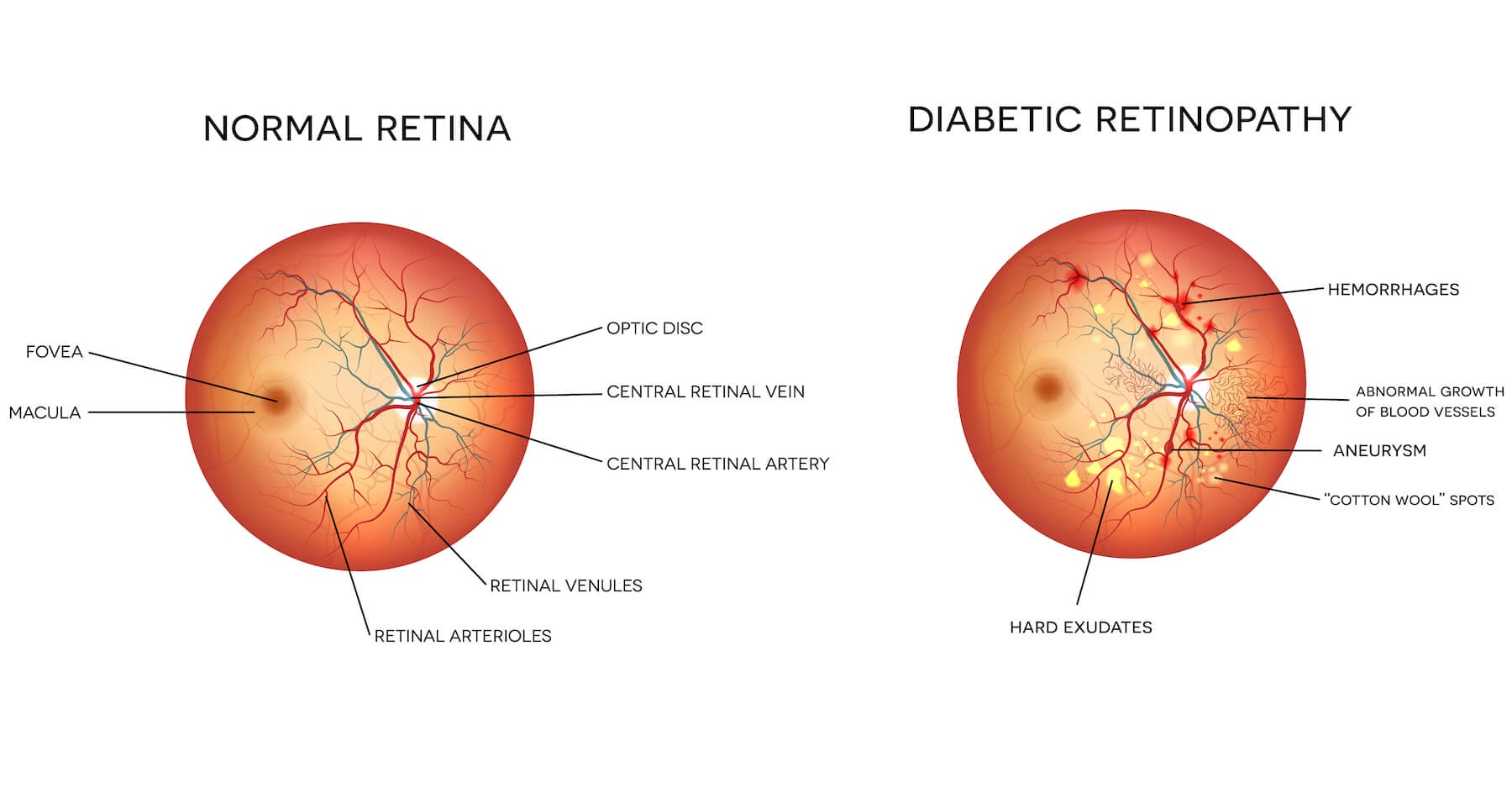 normal eye and diabetes retinopathy