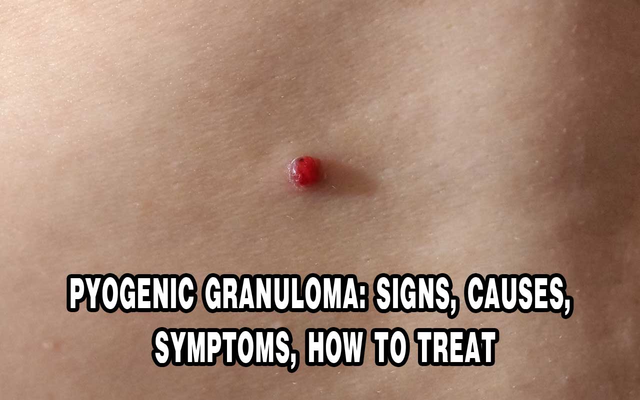 pyogenic granuloma