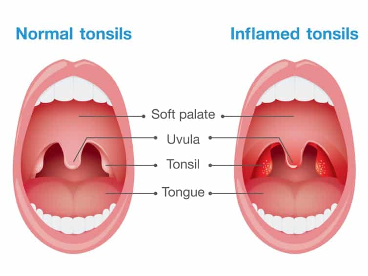 Strep Throat Symptoms