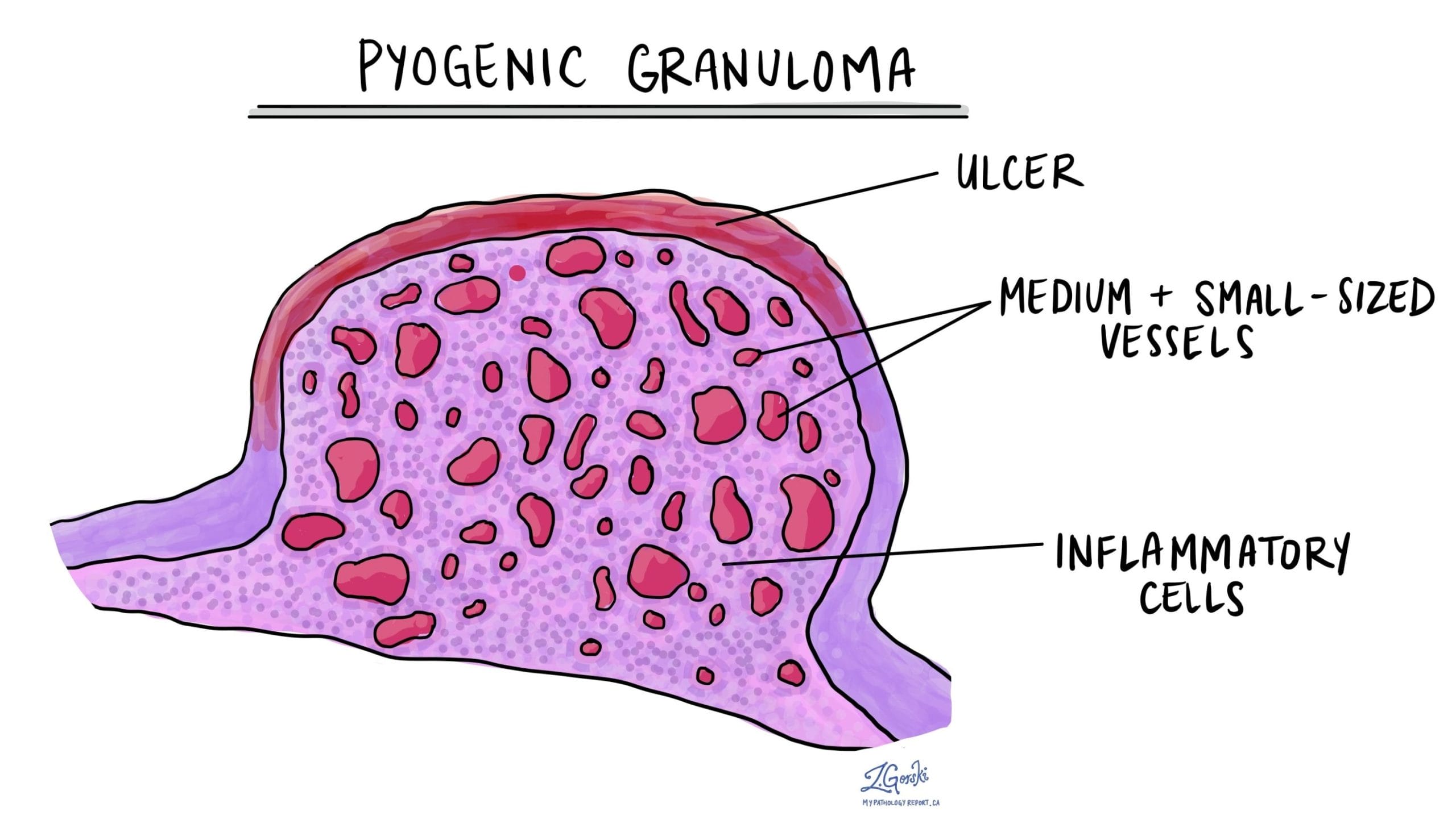 pyogenic granuloma